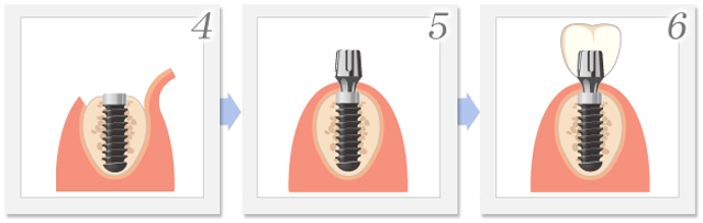 インプラントの埋入手術イメージ2