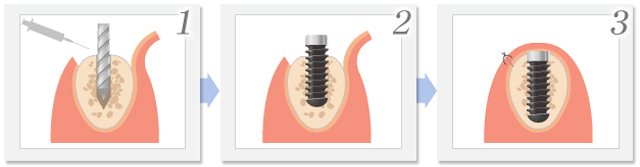 インプラントの埋入手術イメージ1
